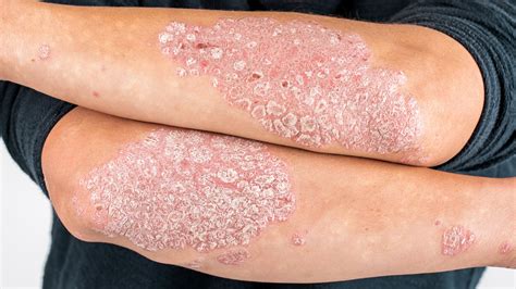 psoriasis skin test results